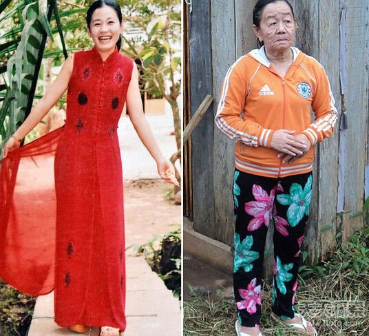 越南一女子过敏后患怪病 短时间内衰老50岁