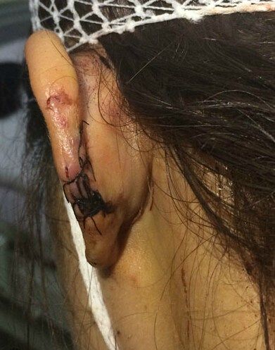 网曝叶璇宠物狗咬伤李依晓 头部缝伤20针画面骇人