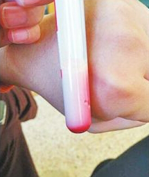 婴儿血液乳白色 宝宝抽血时被发现血液是粉红色