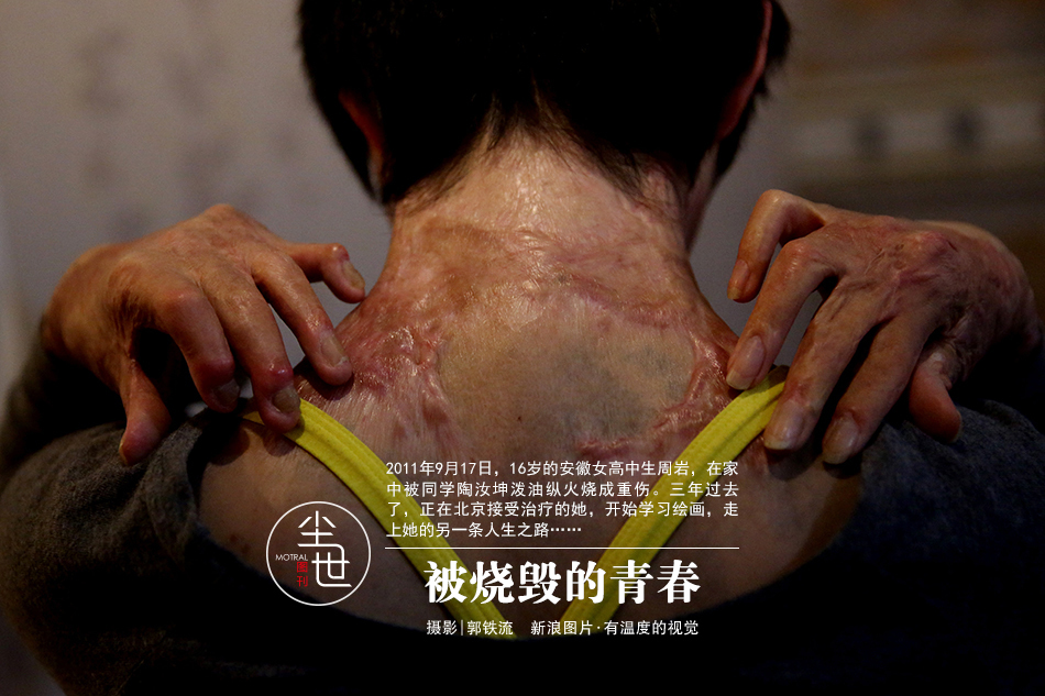 被烧毁的青春：高中生被同学泼油 耳朵完全烧掉