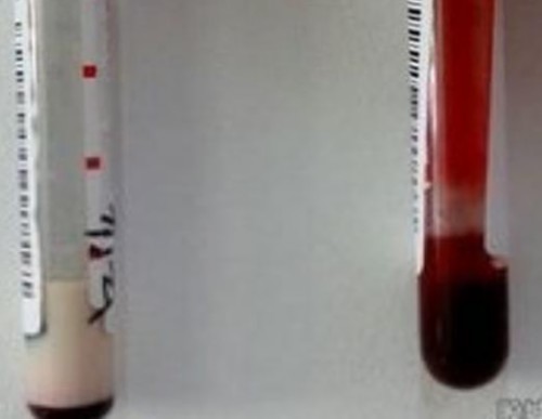 婴儿血液乳白色到底得啥病?如何才能避免