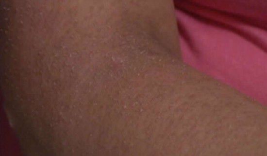 组图：美国女子全身长指甲 系全球罕见怪病