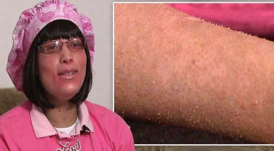 怪病！女子全身长指甲 毛囊布满指甲画面不忍直视