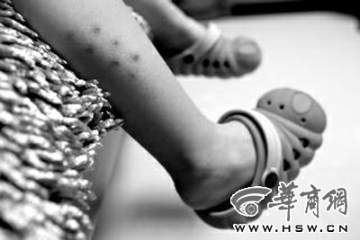 秦都区彩虹幼儿园老师针扎3岁小孩 小腿出现7血点