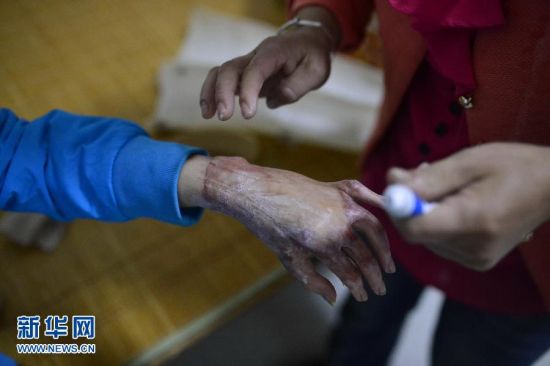 妈妈给周涛脱掉强力套上药,这个过程对母子俩都是一种煎熬。