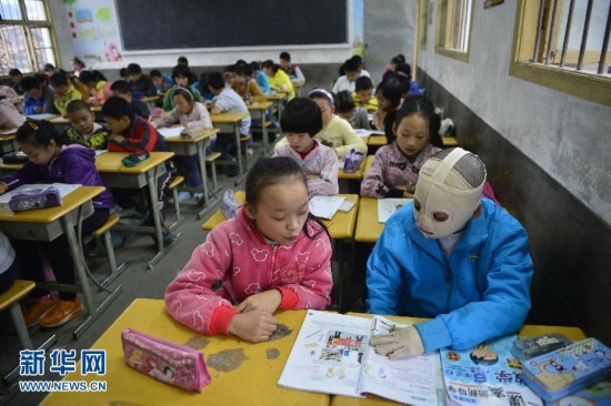 面具男孩：手脸严重烧伤仍坚持上学考第一