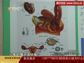 奇事：双子宫双阴道产双胞胎