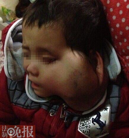 四岁女孩患眼癌不堪痛苦 父母盼能“安乐离世”