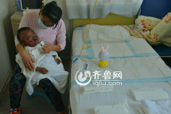 一岁男童患中毒性表皮坏死松解症 全身皮肤如烫伤
